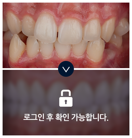 치아교정-전후사진1